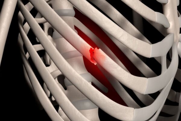 Early SSRF Reduces Mortality and Improves Outcomes in Functionally Dependent Rib Fracture Patients: Study