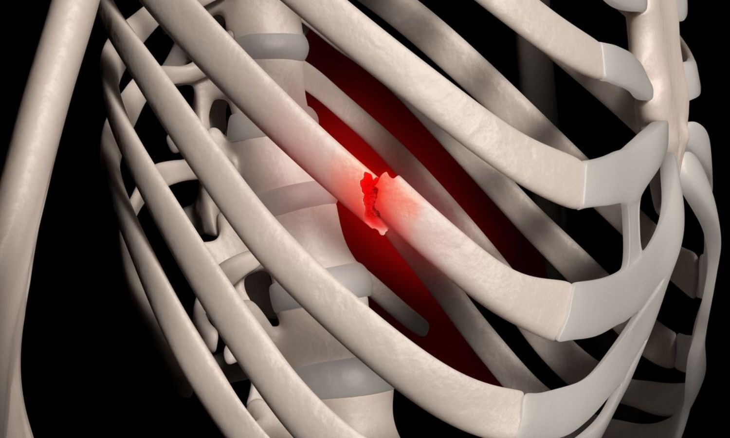 Early SSRF Reduces Mortality and Improves Outcomes in Functionally Dependent Rib Fracture Patients: Study