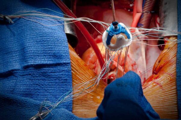 New Study identifies early signs of valve failure one year after TAVI, raising durability concerns in younger patients