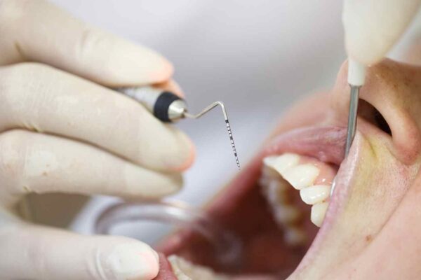 High Blood Sugar Levels Increase the Risk of Periodontal Disease: Study