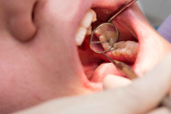 Predicta Bioactive Bulk as effective as 3M Filtek Bulk Fill in Class V Caries Restoration, Suggests Study
