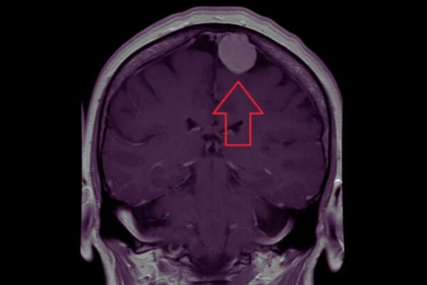 Depot Medroxyprogesterone Acetate Use Linked to Higher Meningioma Risk in Women: JAMA