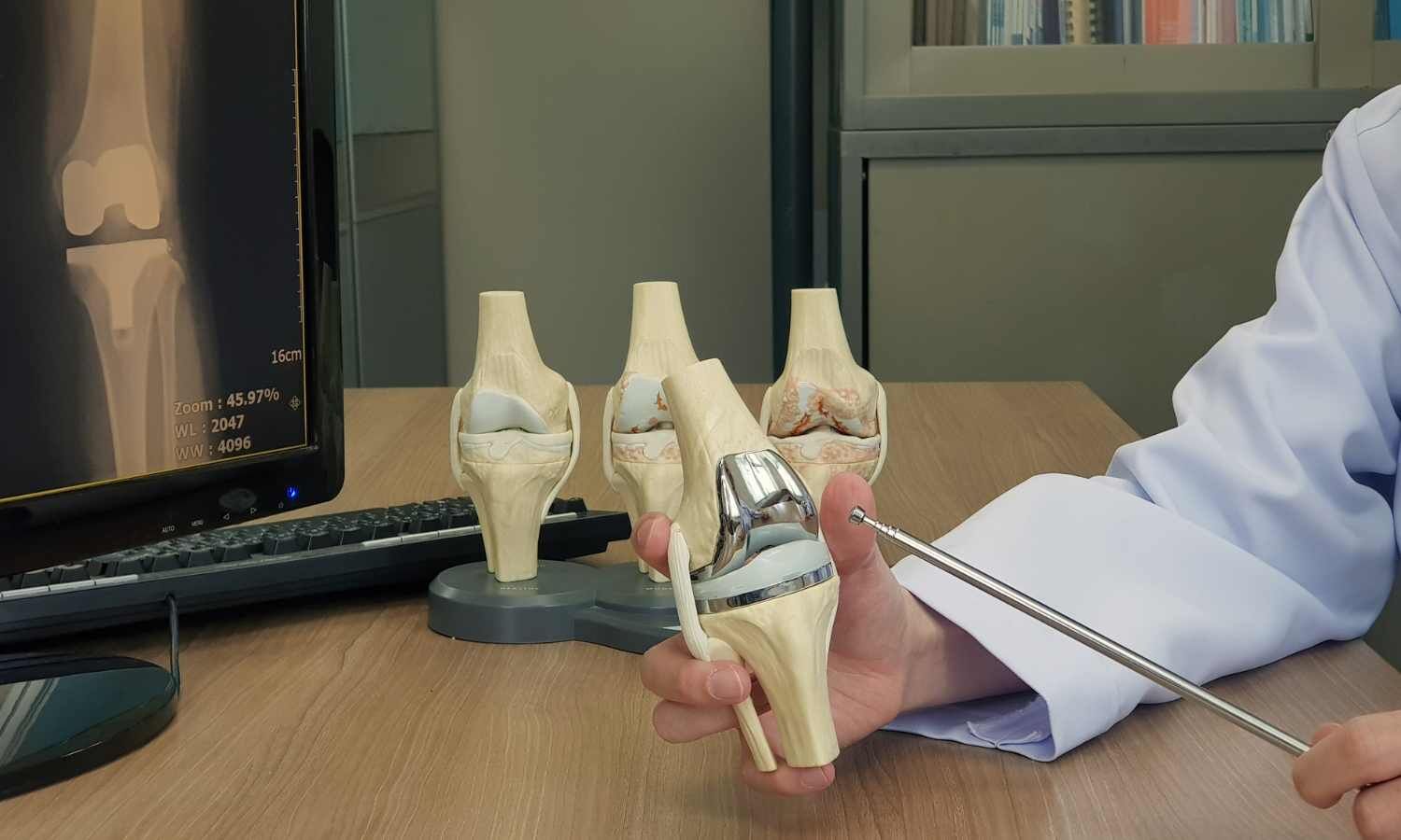 NPPA Extends Price Cap on Knee Implants Until November 15, 2025