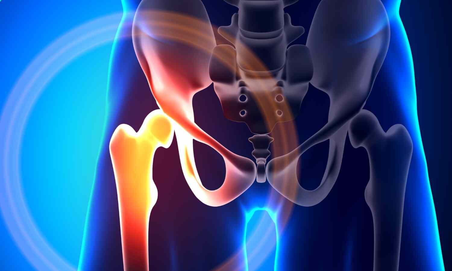 Family History of Fracture Significantly Raises Future Fracture Risk: Meta-Analysis Finds