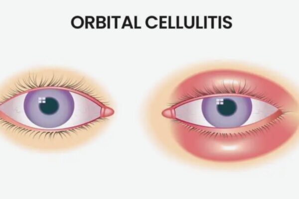 High Surgical Rate in Orbital Cellulitis Demands Targeted Management: Study High Surgical Rate in Orbital Cellulitis Demands Targeted Management: Study