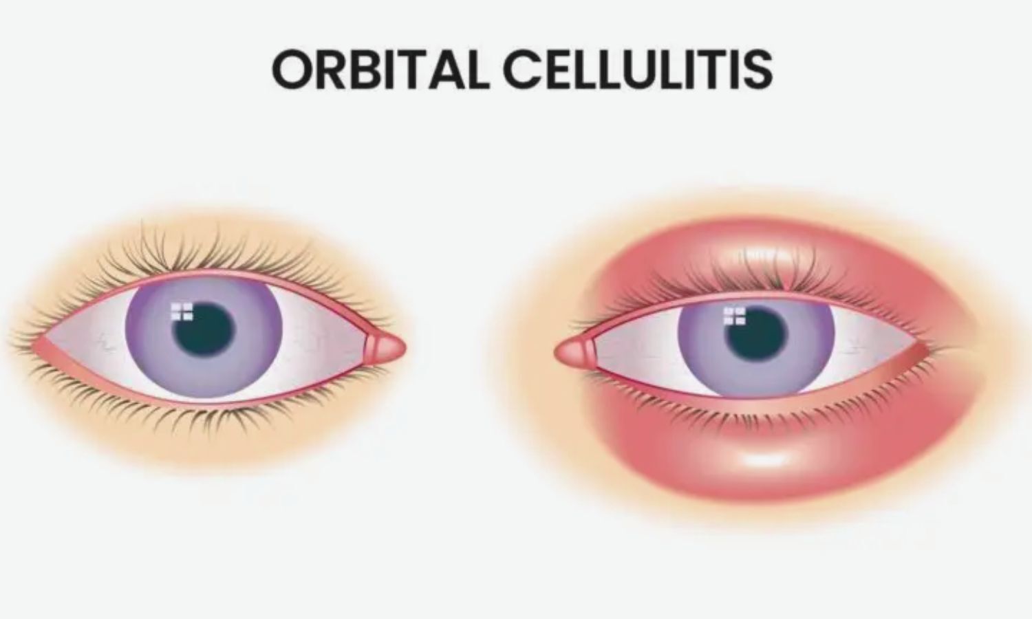 High Surgical Rate in Orbital Cellulitis Demands Targeted Management: Study