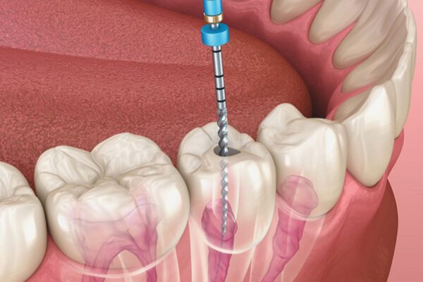 Nanoparticles Could Revolutionize Endodontics — Promise and Practical Hurdles: Study Nanoparticles Could Revolutionize Endodontics — Promise and Practical Hurdles: Study