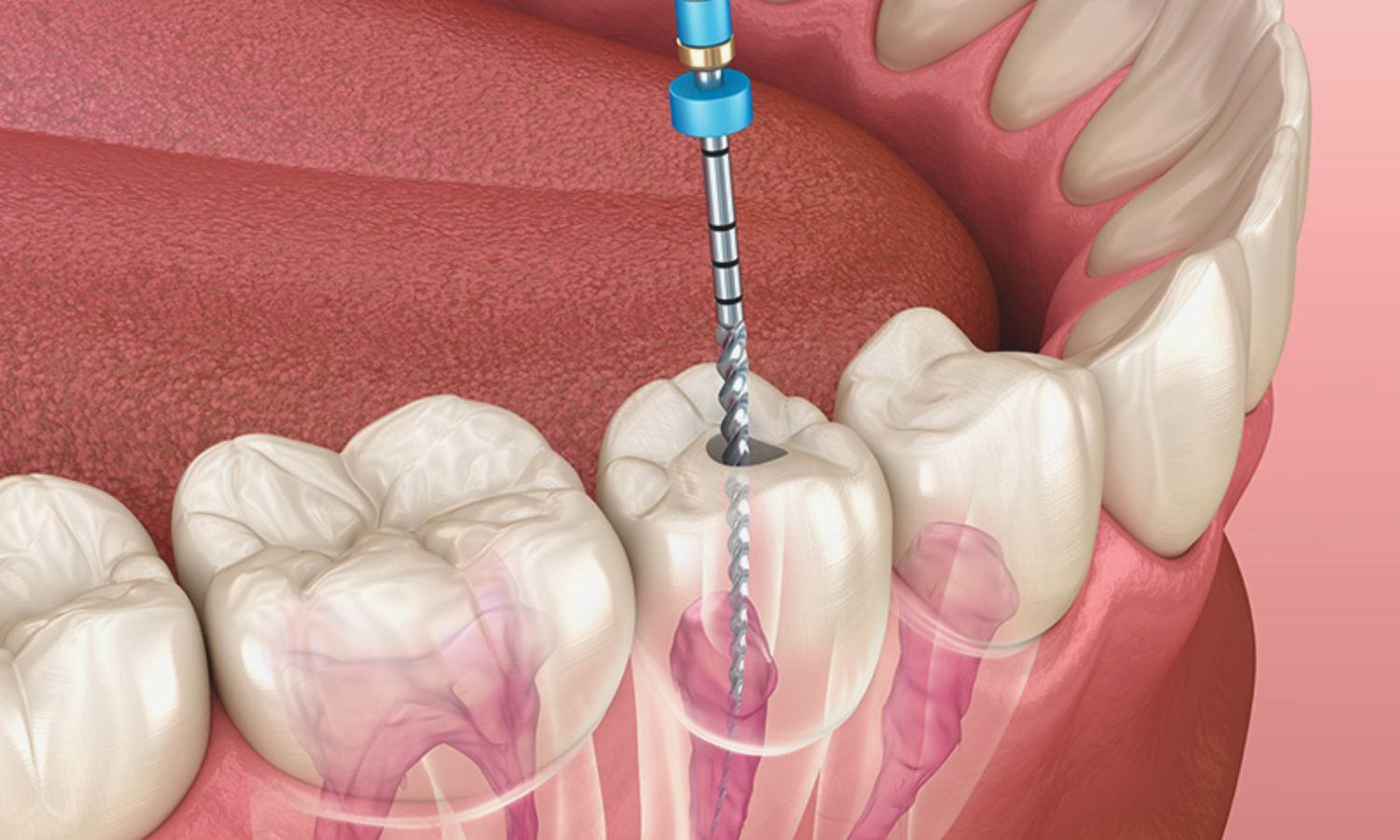 Nanoparticles Could Revolutionize Endodontics — Promise and Practical Hurdles: Study