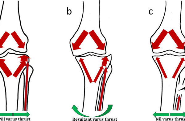 PFO effectively alleviates pain and enhances joint function in patients with medial compartment OA: study
