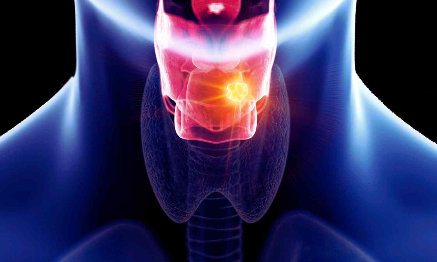 AI could soon detect early voice box cancer from the sound of your voice, suggests study