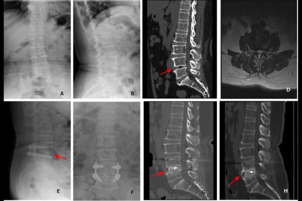 Sarcopenia fails to impact radiological outcomes of patients with degenerative lumbar scoliosis undergoing posterior surgical procedures: Study