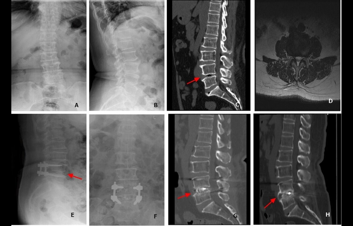 Sarcopenia fails to impact radiological outcomes of patients with degenerative lumbar scoliosis undergoing posterior surgical procedures: Study