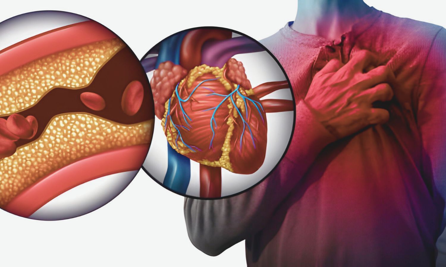 Conduction System Pacing Significantly Reduces PICM and CRT Upgrade Need in AV Block Patients: CSPACE Trial