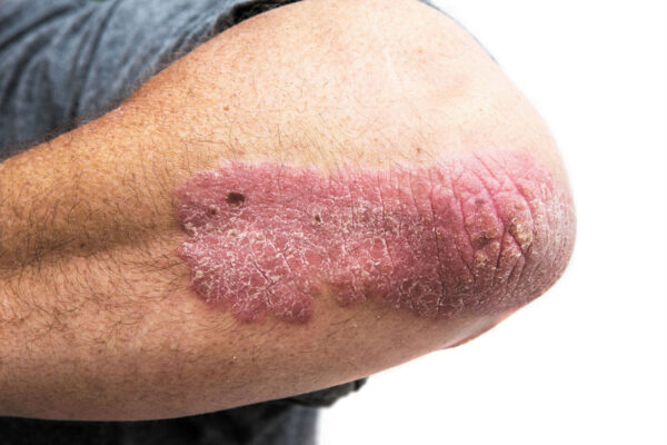 Infection Risk among HS Patients Compared to Psoriasis: JAMA