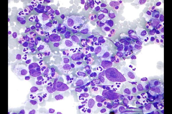 Cervical Cancer and Hodgkin Lymphoma Linked to Higher ASCVD Risk: Study