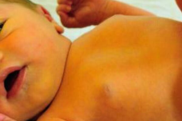 Neonatal Jaundice Linked to Higher Risk of Childhood Asthma, New Study Finds