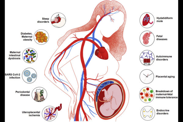 Interpregnancy Weight Change Increases Risk of Preeclampsia in Second Pregnancy: Study