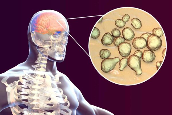 Kerala doctors treat first case of dual brain infection