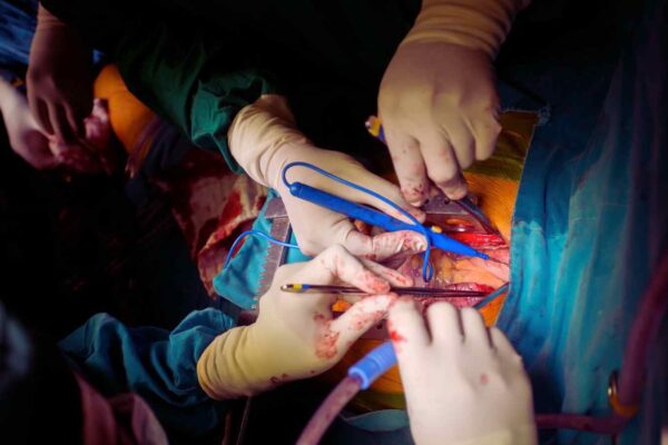 Dual antiplatelet therapy not more effective than aspirin alone after CABG: Study Dual antiplatelet therapy not more effective than aspirin alone after CABG: Study