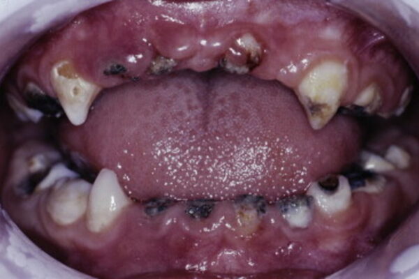 Dental Caries and BMI have bidirectional association among Deprived Adolescents, suggests study