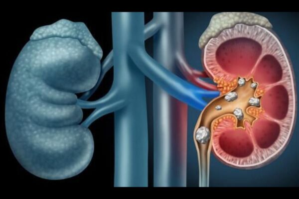 Rheumatoid Arthritis Patients Face Higher Risk of Kidney Stones: Study