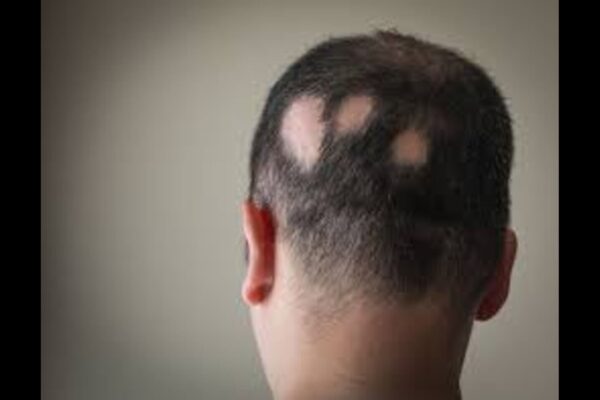 Upadacitinib Shows Safety and Efficacy in Adolescents with Severe Alopecia Areata: Study