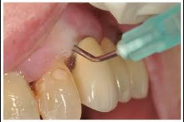 Ozonated Water Shows Modest Benefits in Periodontal Therapy: Study