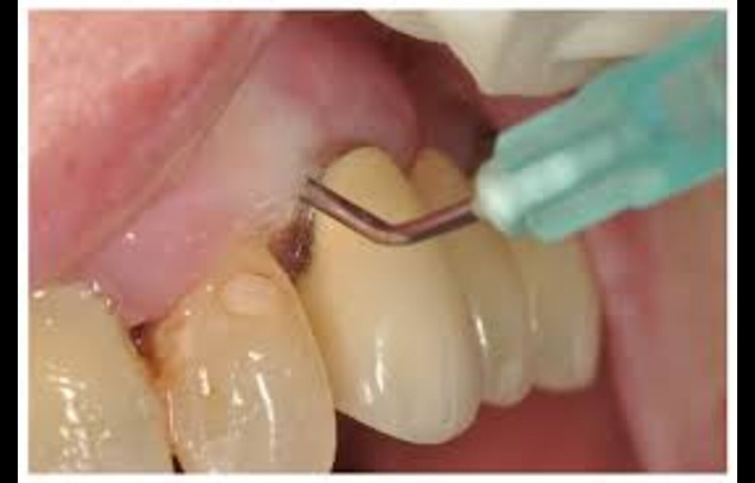 Ozonated Water Shows Modest Benefits in Periodontal Therapy: Study