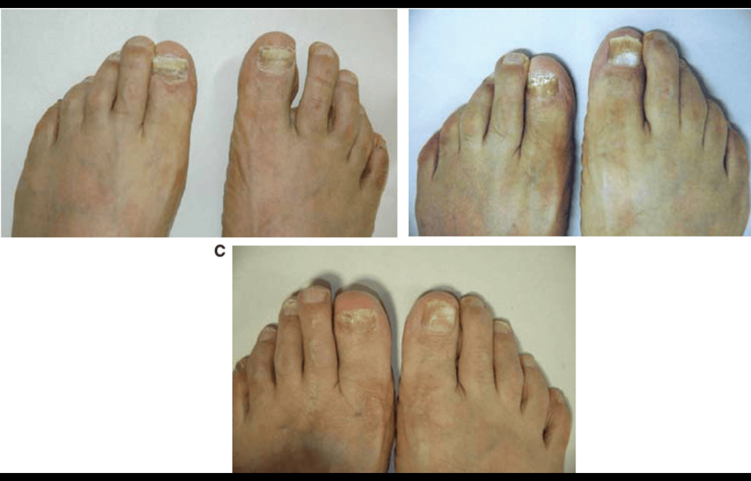 Crisaborole Boosts Effectiveness of Amorolfine in Keratinized Tinea Foot: Study