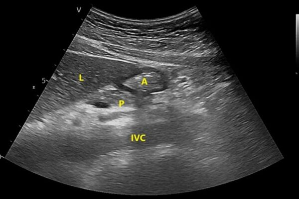 Preoperative Carbohydrate Loading Benefits in Liver Resection: Study