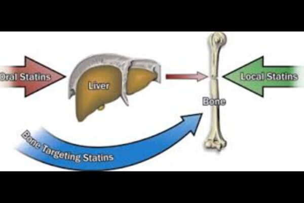Statins Do Not Reduce Bone-Building Benefits of teriparatide in Severe Osteoporosis: Study
