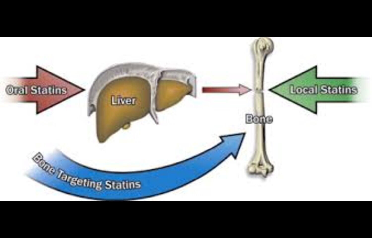 Statins Do Not Reduce Bone-Building Benefits of teriparatide in Severe Osteoporosis: Study