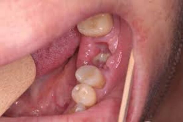 Subcutaneous platelet-rich fibrin Infiltration After Wisdom Tooth Extraction Reduces Pain, Swelling, and Speeds Healing: Study