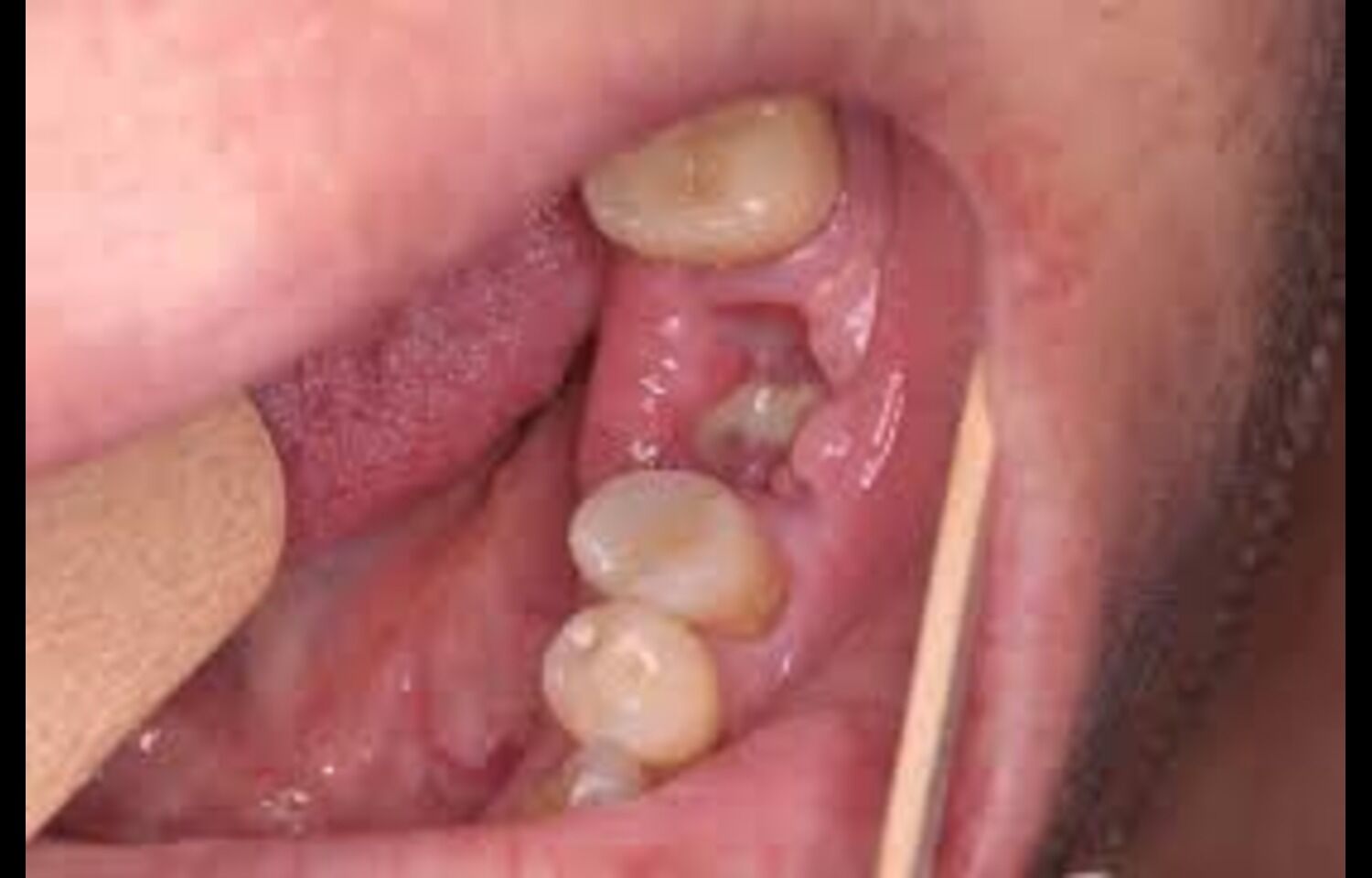 Subcutaneous platelet-rich fibrin Infiltration After Wisdom Tooth Extraction Reduces Pain, Swelling, and Speeds Healing: Study