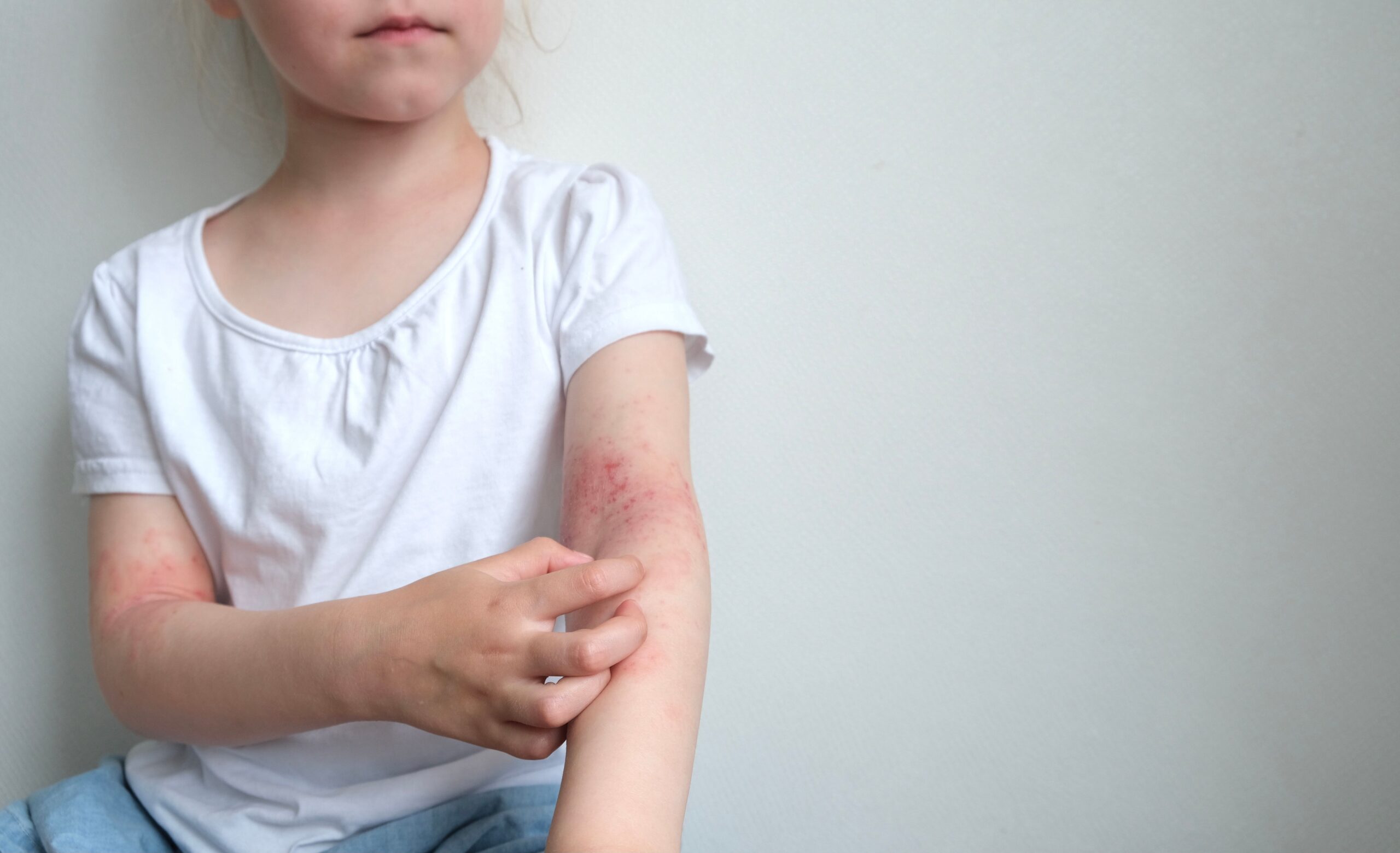 FDA Expands Opzelura Approval to Children as Young as Two With Atopic Dermatitis