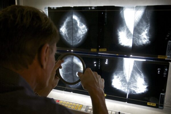 New breast cancer screening trial may answer key AI question