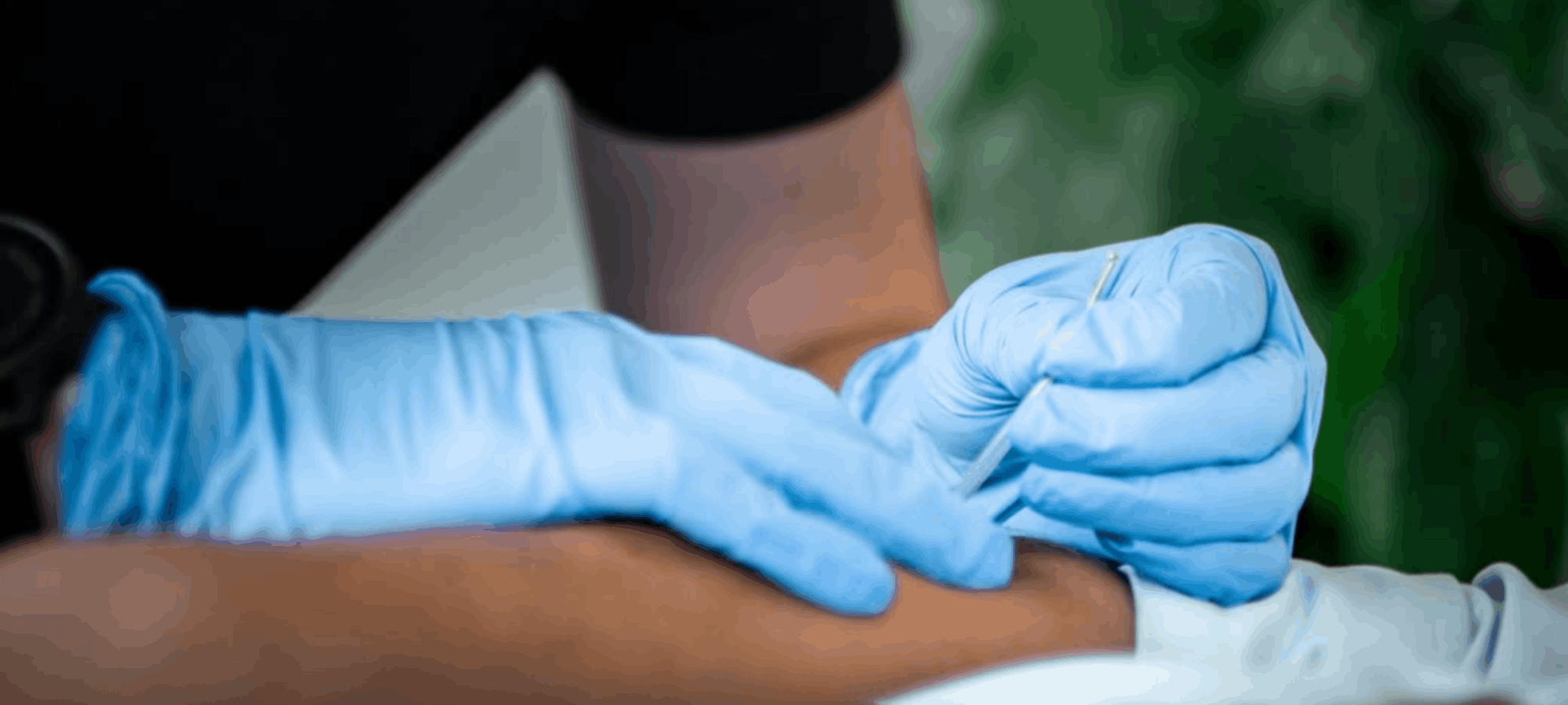 Dry Needling vs Acupuncture: What’s the Difference?
