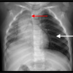 Persistent cough in a child