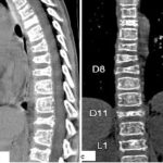 From initial common back pain in a child to final diffuse metastatic rhabdomyosarcoma