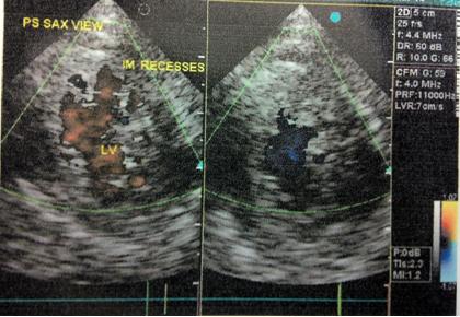 Biventricular non-compaction (spongiform) cardiomyopathy | Pediatric Oncall Journal