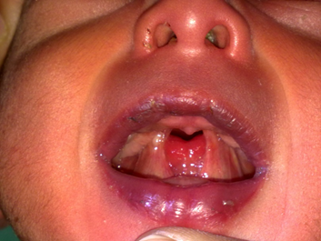 Cleft palate with lateral synechiae syndrome