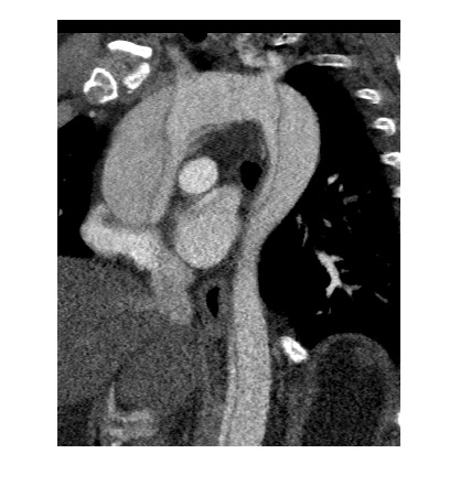 Imaging Case of the Week 468 Answer