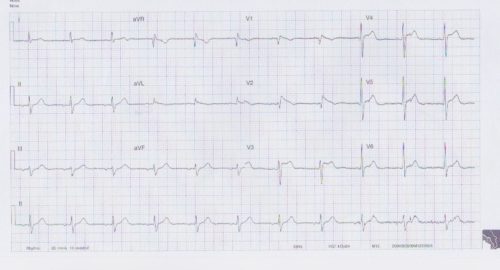 ECG of the Week – 28th April 2020
