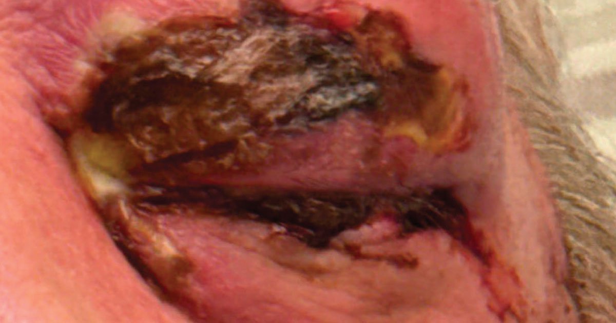 Man presents with bilateral upper, lower eyelid swelling