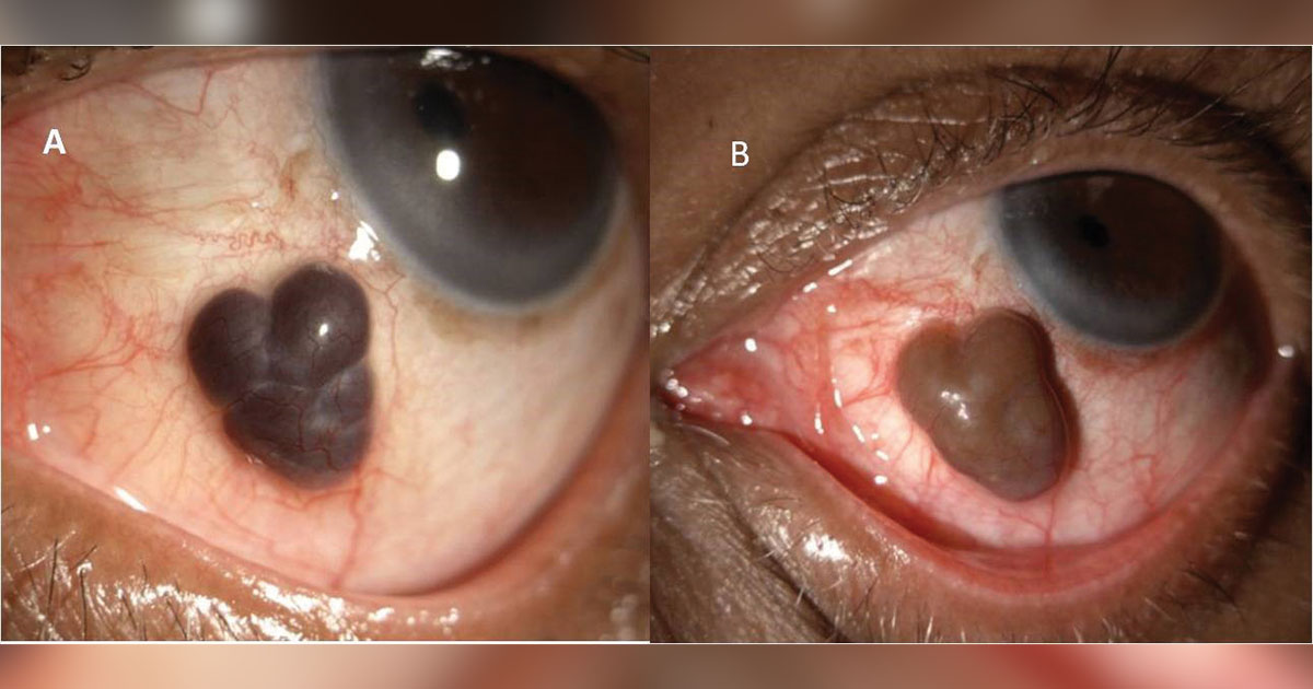 Oncocytic inclusion cyst of conjunctiva following vitrectomy