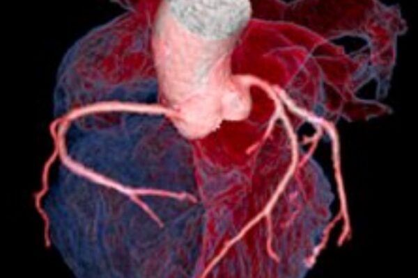 GDF-15 Linked to Short-Term Adverse Outcomes in Suspected ACS Patients, reveals research