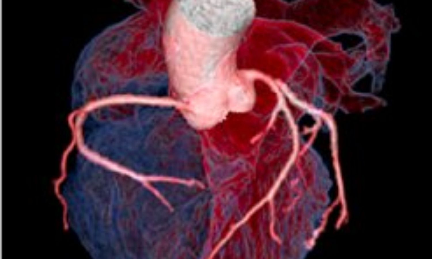 GDF-15 Linked to Short-Term Adverse Outcomes in Suspected ACS Patients, reveals research