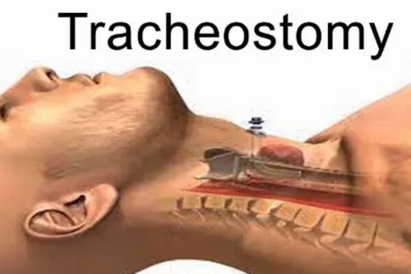 Petroleum Jelly Outperforms Saline in Preventing Tracheostomy Pressure Injuries: Study