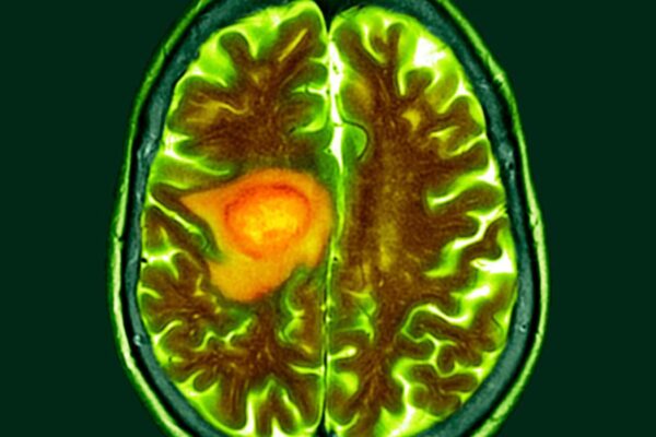 How Hydralazine Inhibits Growth of Glioblastoma, Study Sheds Light