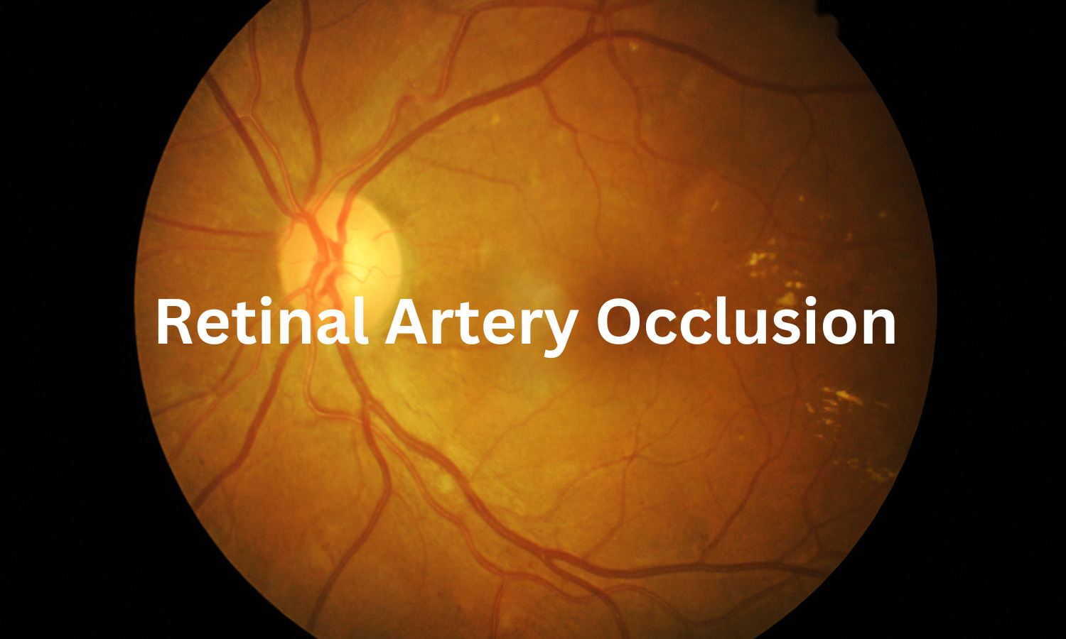 Retinal Artery Occlusion Significantly Increases Risk of Ischemic Stroke: Meta-Analysis Shows
